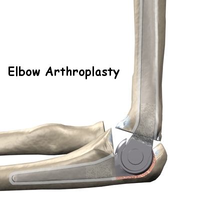 Artificial Joint Replacement of the Elbow