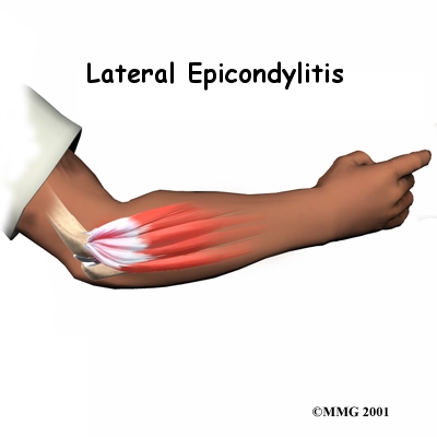 A Patient's Guide to Lateral Epicondylitis