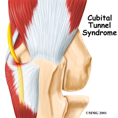 Cubital Tunnel Syndrome  Saint Luke's Health System